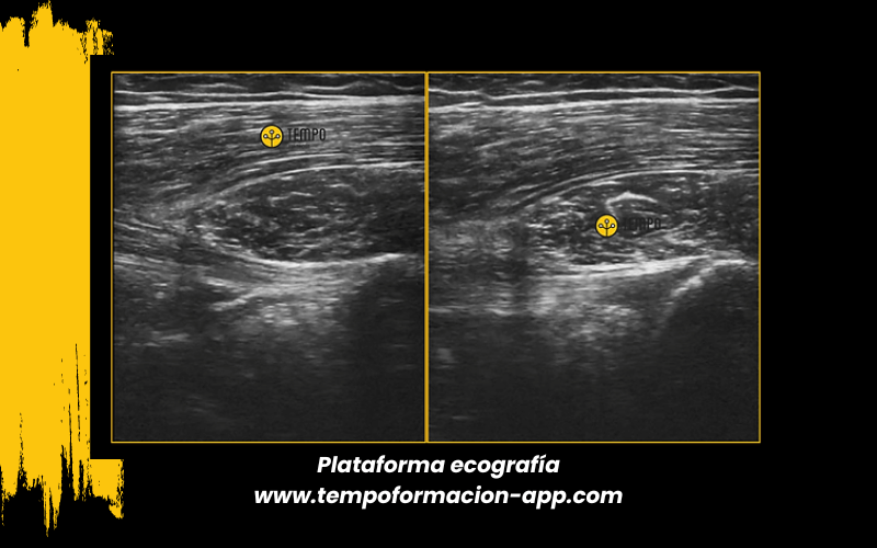 4. Ecografia tempo formacion manguito rotador tendon supraespinoso infraespinoso redondo menor subescapular.png